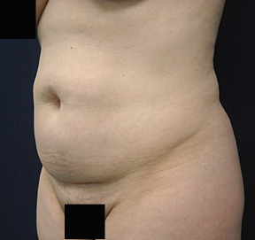 Chicago Tummy Tuck, Chicago Abdominoplasty, mini tummy tuck pictures, tummy tuck, panniculectomy, Chicago Tummy Tuck Surgery, Chicago Abdominoplasty Surgery, tummy tuck photo, tummy tuck picture, Panniculectomy Surgery, Chicago Panniculectomy Surgery, abdominoplasty photo, abdominoplasty picture, tummy tuck in chicago